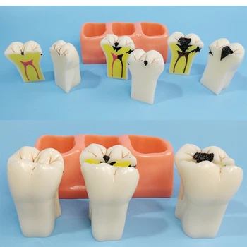 Odontologinės medžiagos, dantų mokymo modelį patologinį dantų modelio plieno jade dantų modelio švietimo, mokymo įranga